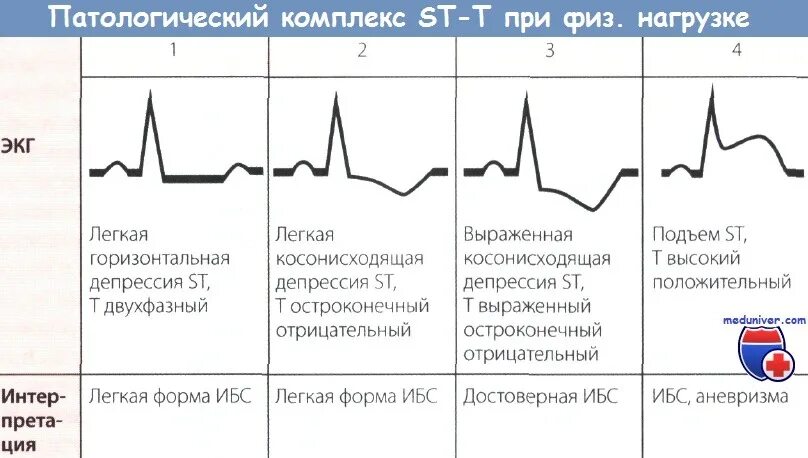 Нарастание зубца. Сегменты ЭКГ В норме и патологии. Отрицательный зубец р после QRS комплекса. Сегмент St на ЭКГ В норме. Зубец т на ЭКГ норма и патология.