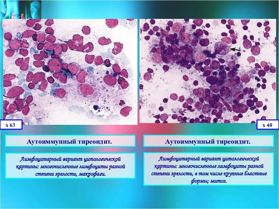 Цитологический атлас щитовидной железы Шапиро. АИТ цитологическая картина. Фолликулярная карцинома щитовидной железы гистология. Лимфоцитарный цервицит цитология. Лимфоцитарный тиреоидит