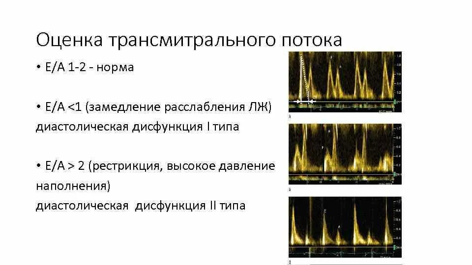 Нарушение функции лж по 1 типу. Трансмитральный кровоток норма. трансмитральный диастолический поток. оценка трансмитрального потока. типы нарушения диастолической функции лж.