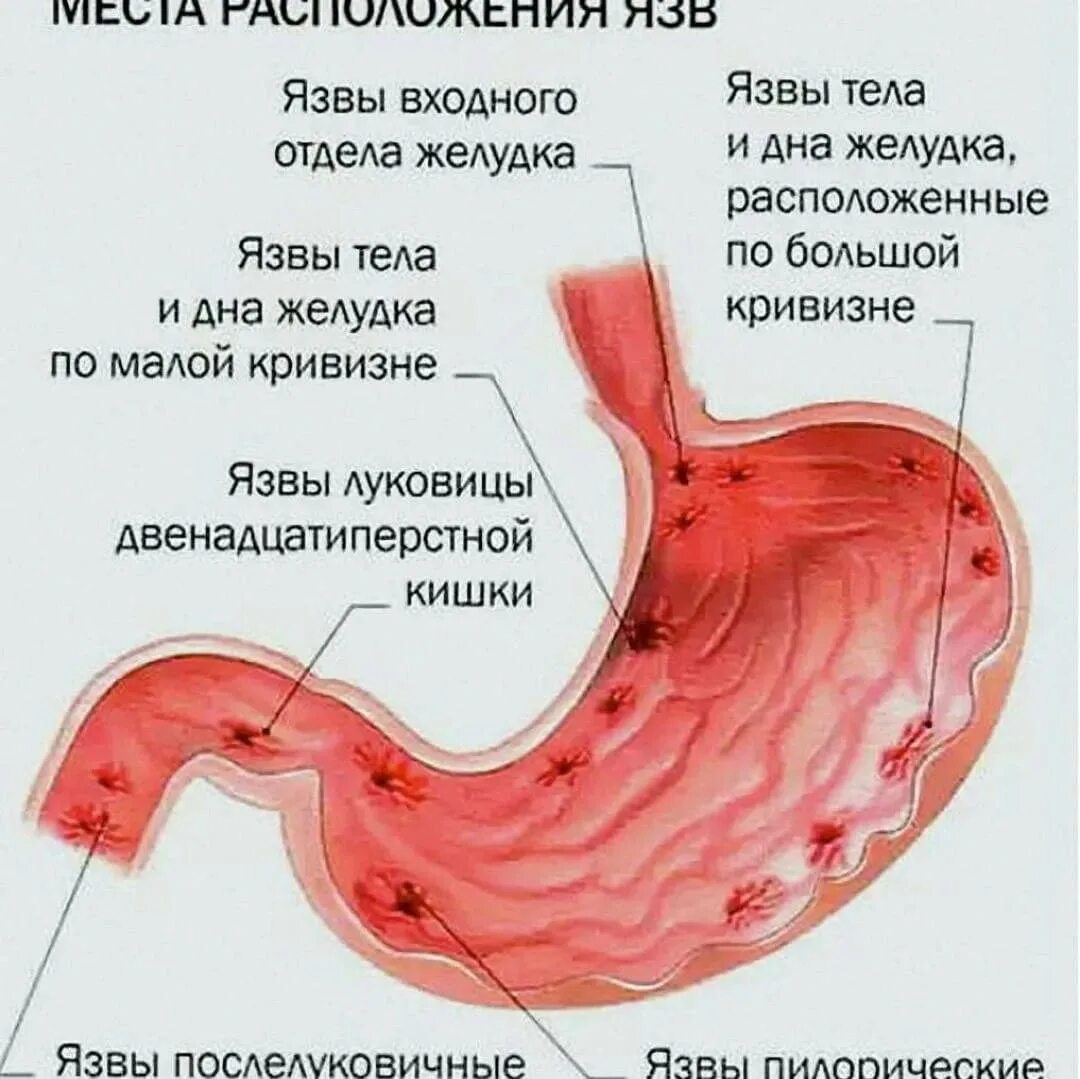 Какие боли желудка бывают. Язвенная болезнь желудка язвенная болезнь 12 перстной кишки. Язвенная болезнь 12 перстной кишки. Язвы 12 перстной кишки располагается. Язва желудка и 12 перстной кишки.