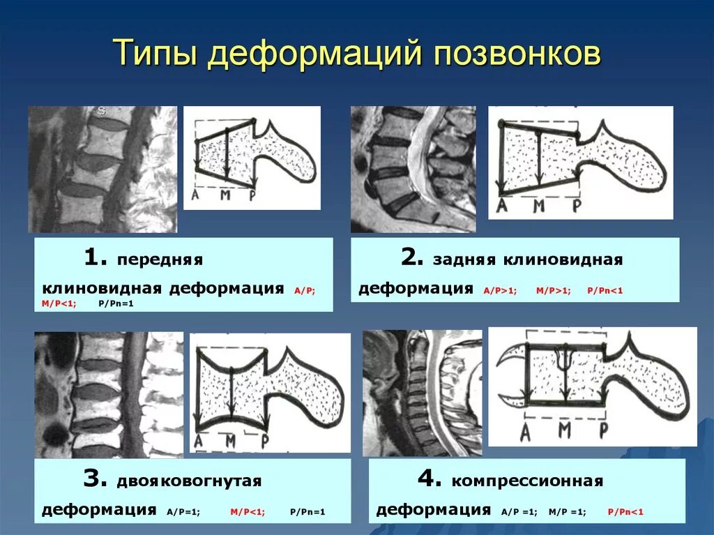 Компрессионный перелом th7. Степени деформации тел позвонков перелом. Клиновидная деформация тела позвонка рентген. Компрессионный перелом позвонков l3 l4. Компрессионный перелом тела 1 1