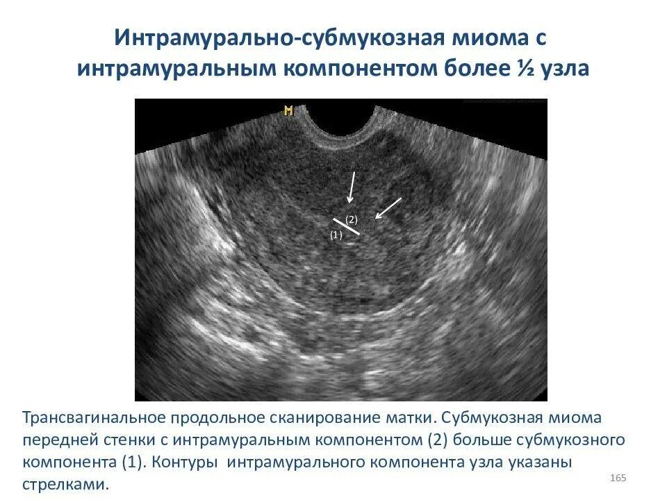 Миома на задней стенке матки. Миомэктомия матки миомэктомия. Интрамуральная миома матки УЗИ. Множественная миома матки УЗИ.