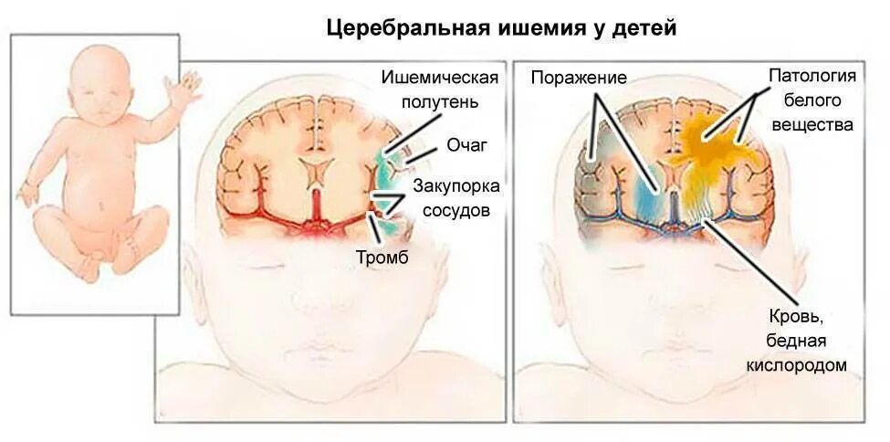 Ишемия головного мозга у новорожденного. Ишемия головы у новорожденного. Церебральная ишемия 1 степени у новорожденного. Ишемическое поражение головного мозга у новорожденных. Гипоксические изменения головного мозга