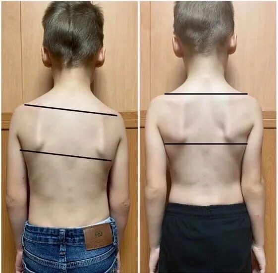 Операция при сколиозе Пикабу