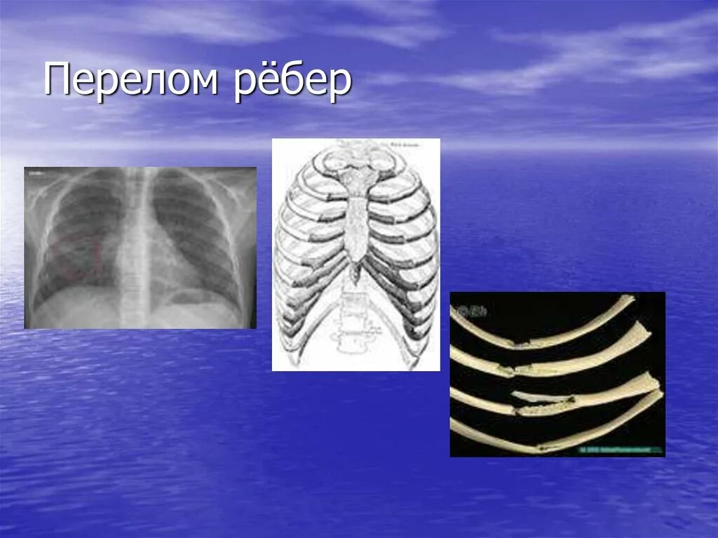 Одиночный перелом ребер. Поднадкостничный перелом ребра. Перелом ребер осложнения.