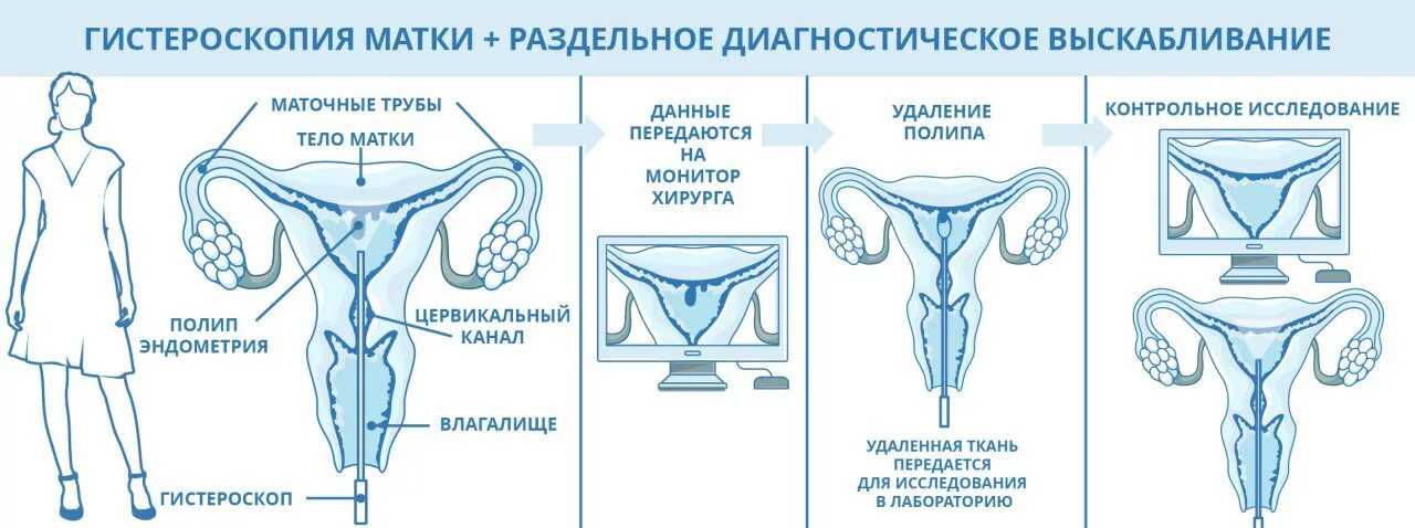 Раздельное диагностическое выскабливание слизистой оболочки матки. Гистероскопия гинекологические операции. Гистероскопия полости матки. Гистероскопия РДВ слизистой матки.