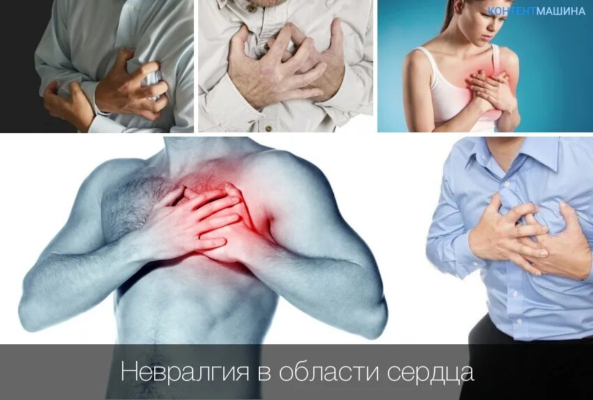 Невралгия стенокардия