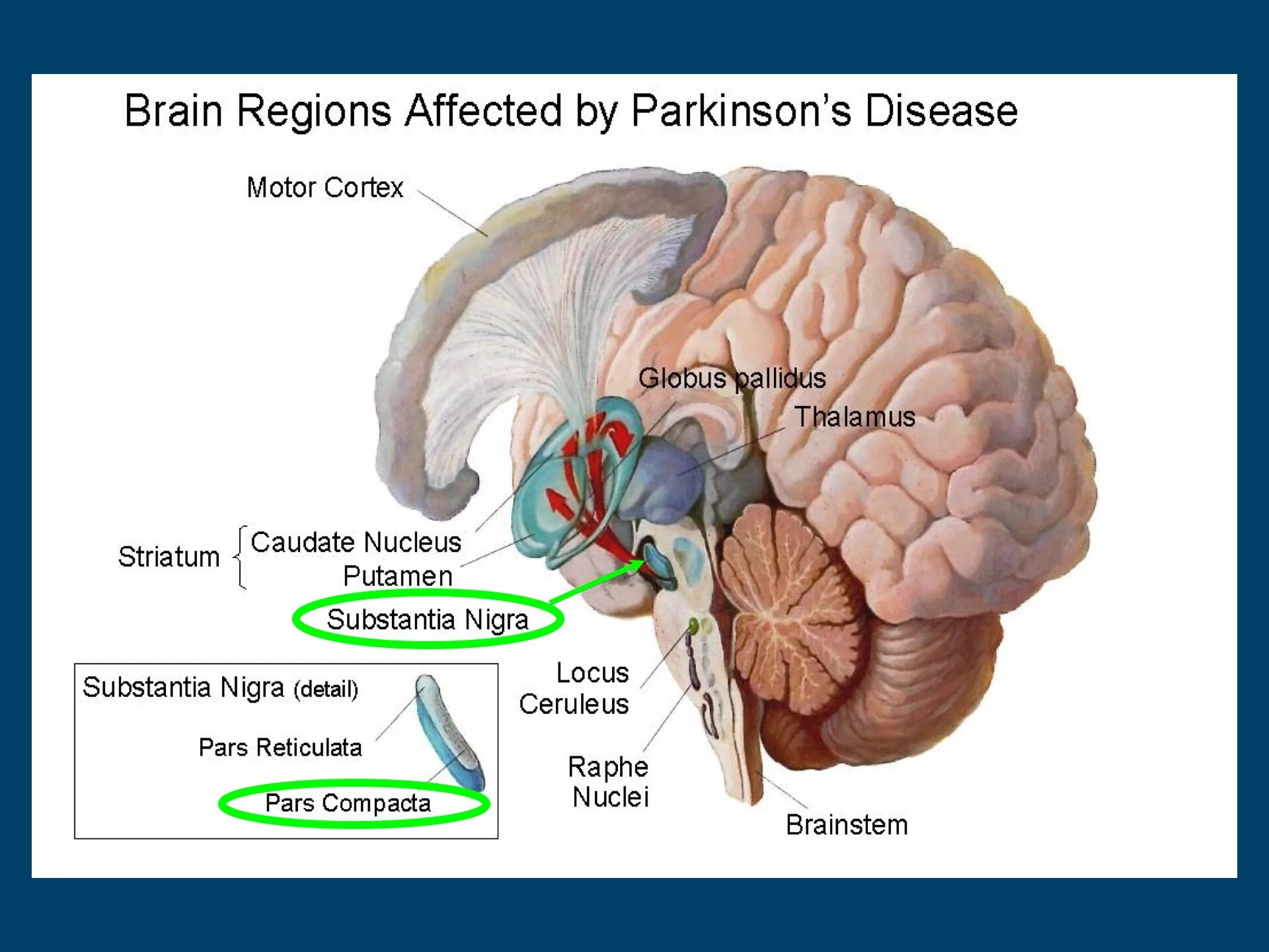 Болезнь Паркинсона мозг. Parkinson's disease.