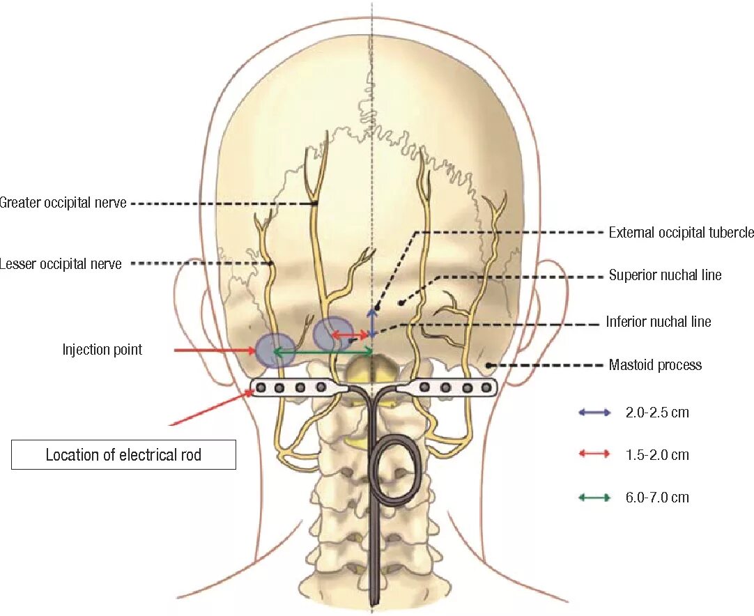 Нейропатия затылочного нерва. Nervus occipitalis Minor. Большой затылочный нерв анатомия. Малый затылочный нерв схема.