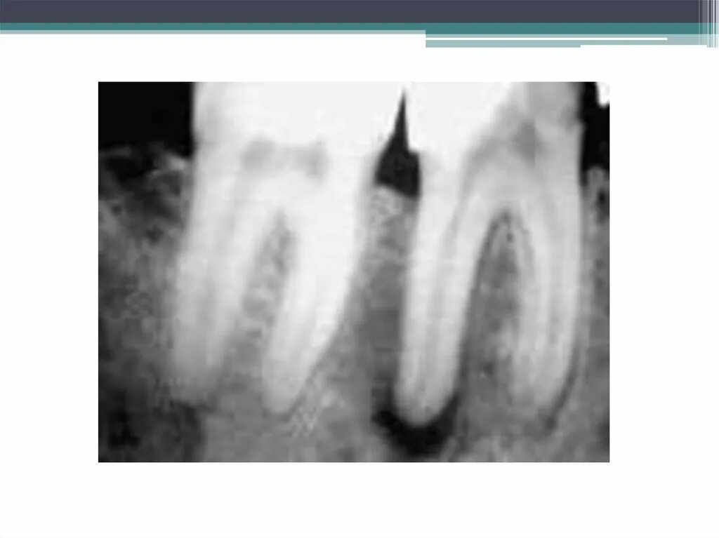 Periodontitis is acute and chronic. Symptoms Treatment. Photo.