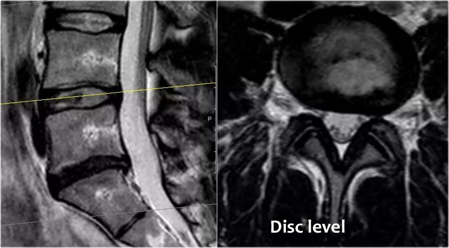 Секвестрированная грыжа диска мрт. Neck disc herniation мрт. Секвестированная грыжа l5s1. Миграция грыжи диска. Секвестрированная грыжа l3 l4.
