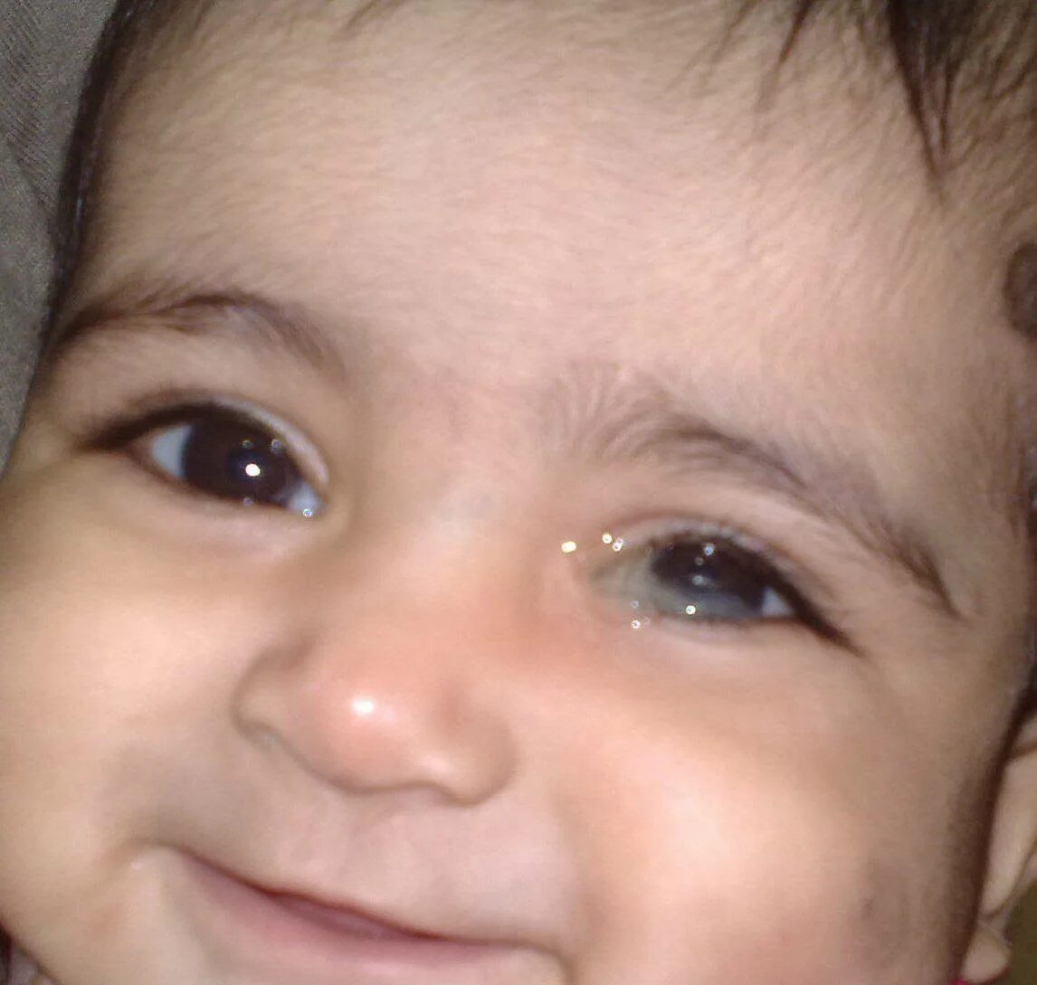 Child conjunctivitis red eye with infection, health. фотография Stock Adobe Stoc