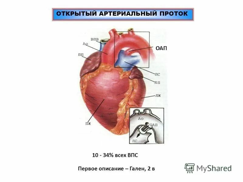 Мкб впс дмжп. Впс открытый артериальный проток. открытый артериальный проток мкб 10. классификация открытого артериального протока.