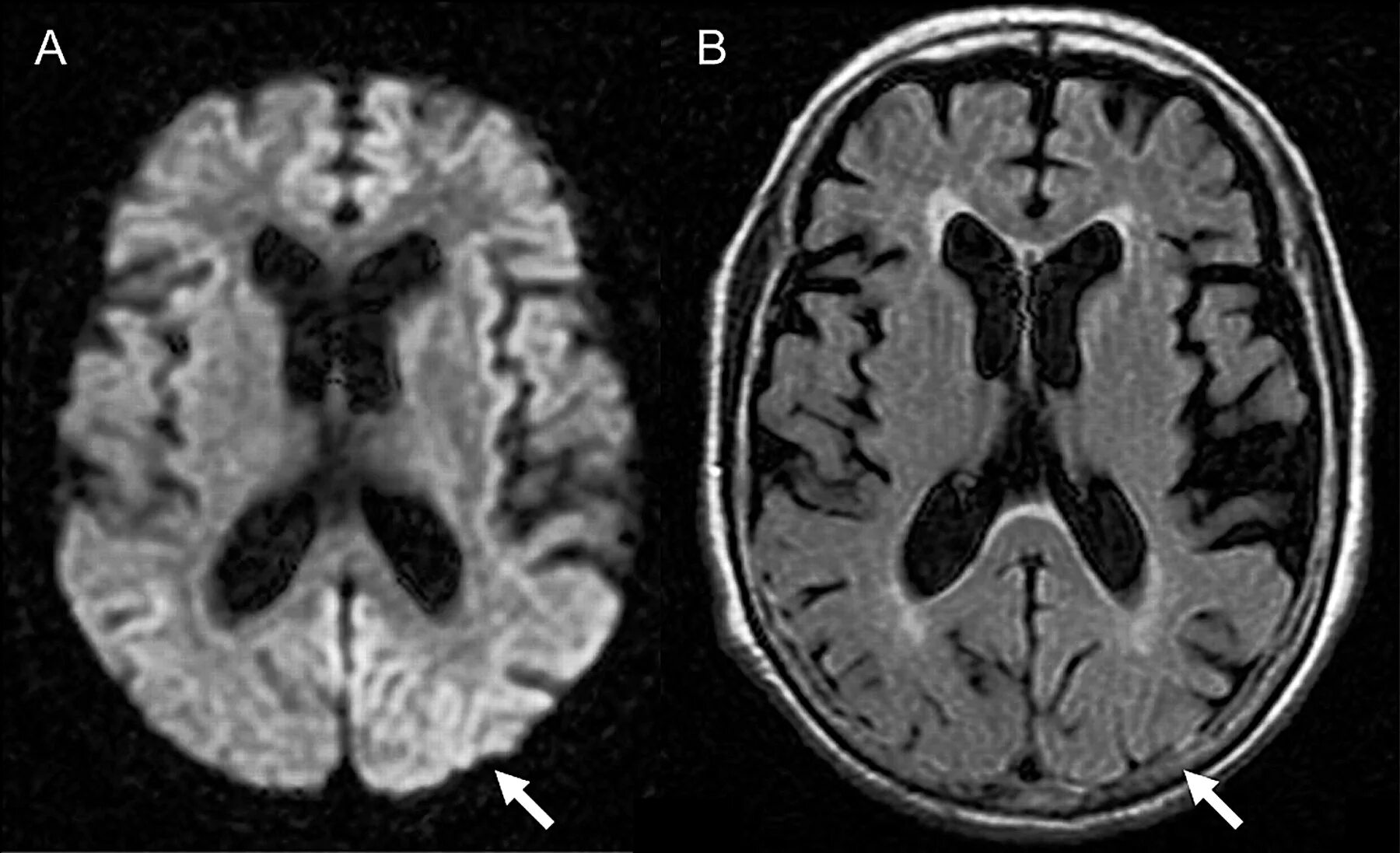 Лейкоэнцефалит