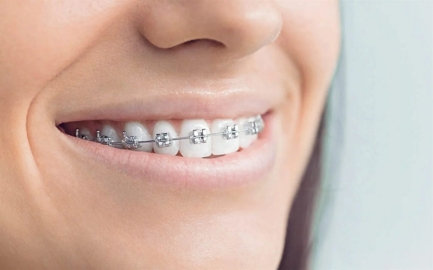 Brackets photo