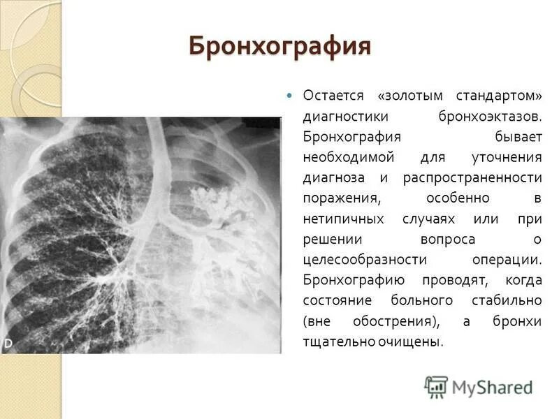 Бронхоэктатическая болезнь грудная клетка. Бронхоэктатическая болезнь грудная клетка. Бронхоэктатическая болезнь грудная клетка. Бронхоэктатической болезни. Бронхоэктаз рентгенограмма.