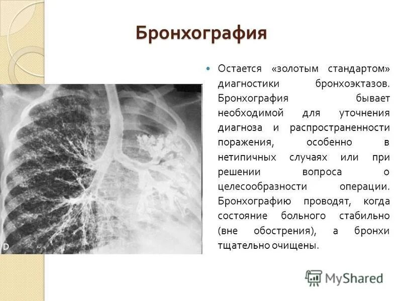 Бронхоэктатическая болезнь диагноз. Бронхография цилиндрические бронхоэктазы. ФБС бронхоэктатическая болезнь. Методы обследования при бронхоэктатической болезни.