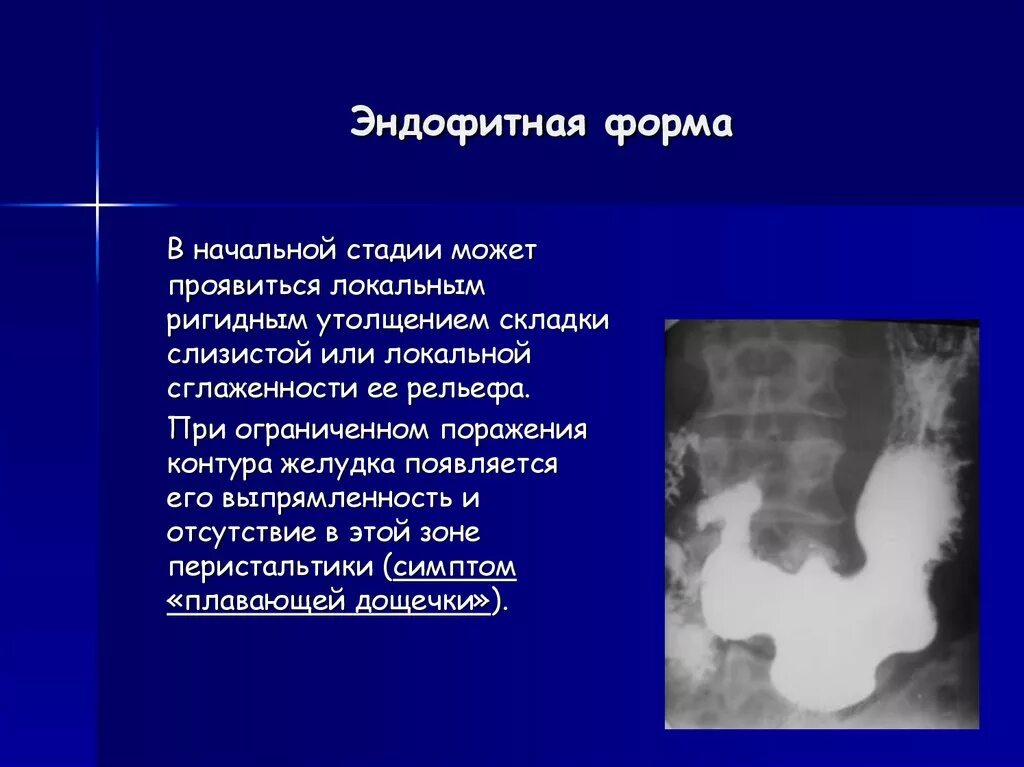 Ирригоскопия опухоль сигмовидной кишки. Опухоль сигмовидной кишки рентген. Эндофитная опухоль желудка. Опухоли желудка рентгенодиагностика. Локальное утолщение слизистой