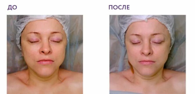 Karboksil terapiya. карбокситерапия (газовые уколы со2). неинвазивная карбокситерапия. карбокситерапия лифтинг. карбокситерапия со2 газом.