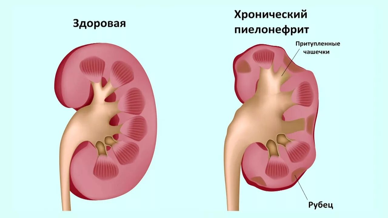 Необструктивный хронический пиелонефрит связанный. Односторонний пиелонефрит. Хронический обструктивный пиелонефрит 11.1. Острый и хронический пиелонефрит.