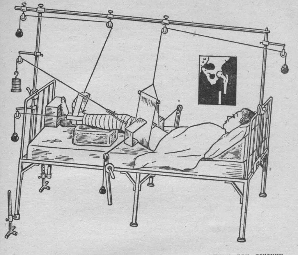 Скелетное вытяжение травматология. Скелетное вытяжение Беллера. Скелетное вытяжение надмыщелки. Скелетное вытяжение при переломе бедренной кости.