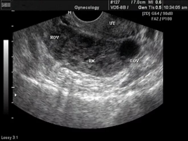 Внематочная беременность на УЗИ. Трубная беременность УЗИ. Нормальная матка на УЗИ.
