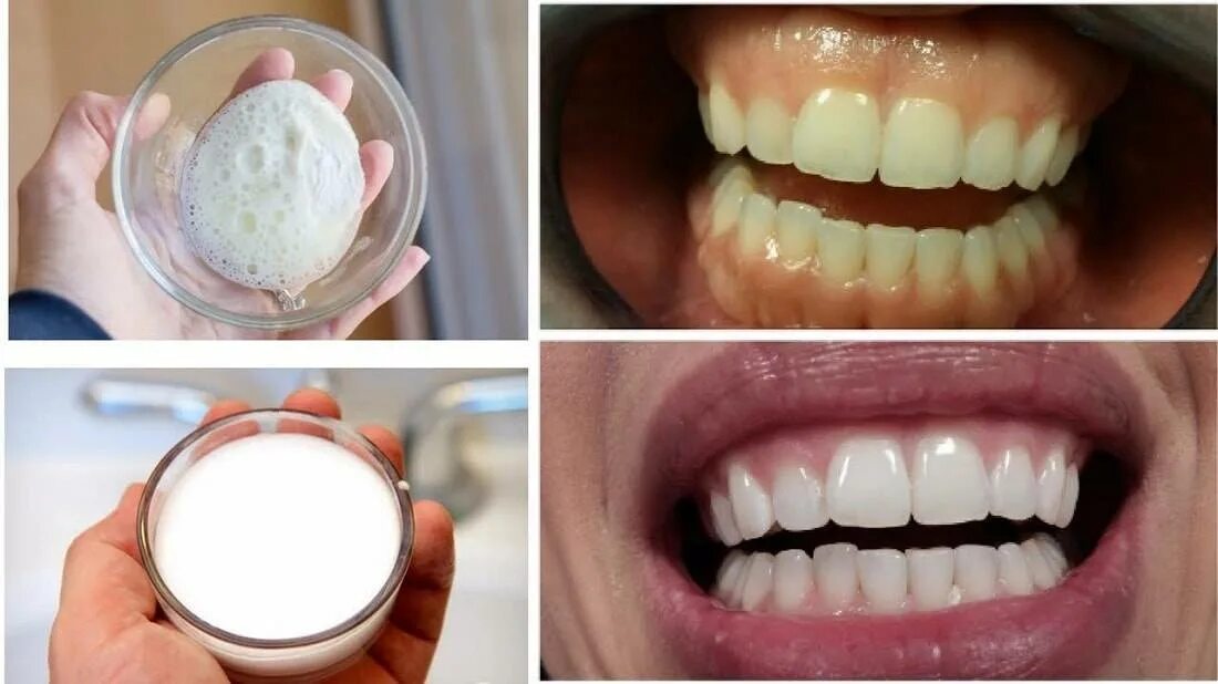 Зуб отбеливание пить. Отбеливание зубов. Отбеливание зубов содой. Чистка и отбеливание зубов. Отбеливание зубной эмали.