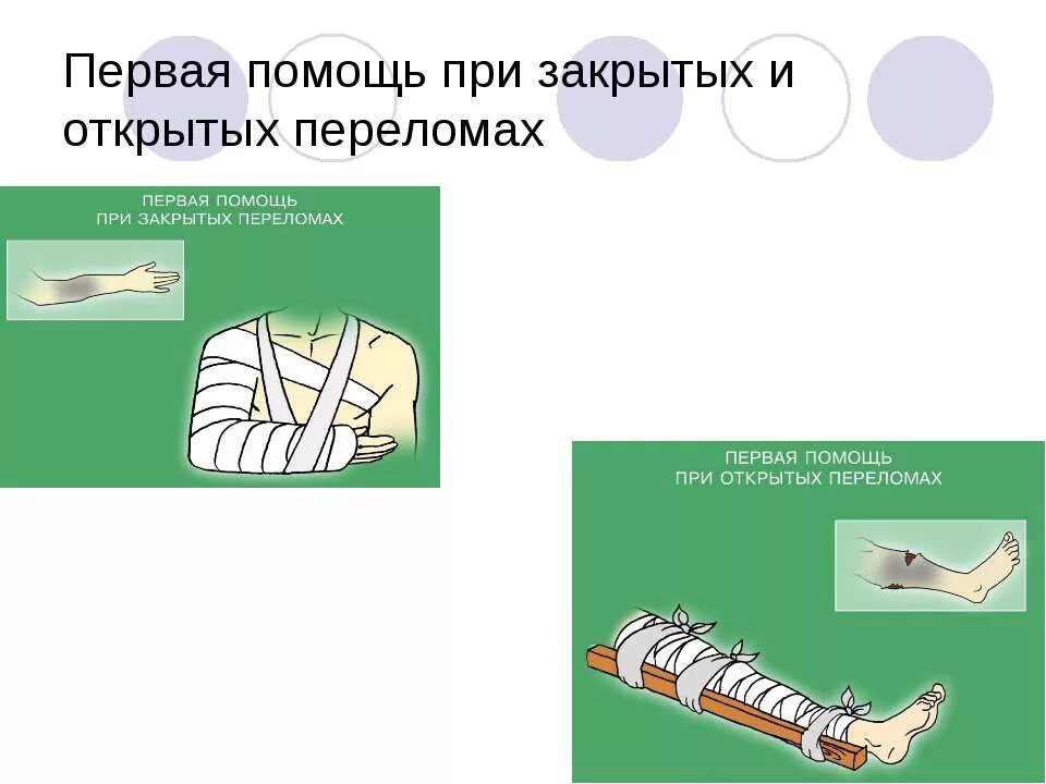 3 первая помощь при открытых переломах. Первая помощь при открытых и закрытых переломах. Первая помощь при закрытом переломе. Первая помощь при открытом и закрытом переломе. ПМП при переломах открытых и закрытых.