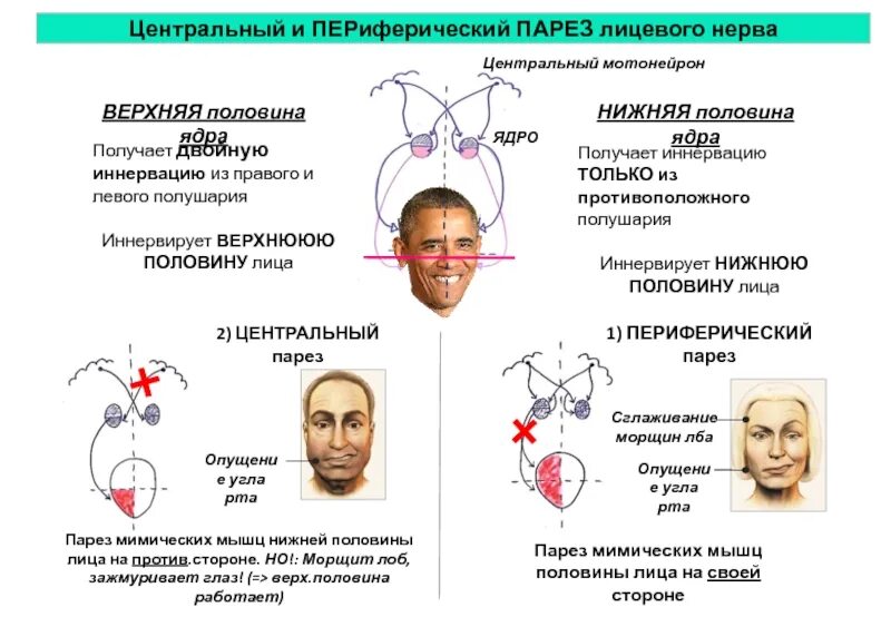 Порез лицевого. Центральный и периферический парез мимической мускулатуры. Периферический парез лицевого нерва. Парез лицевого нерва патогенез. Центральный паралич лицевого нерва симптомы.