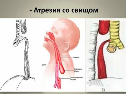 Атрезия пищевода мкб