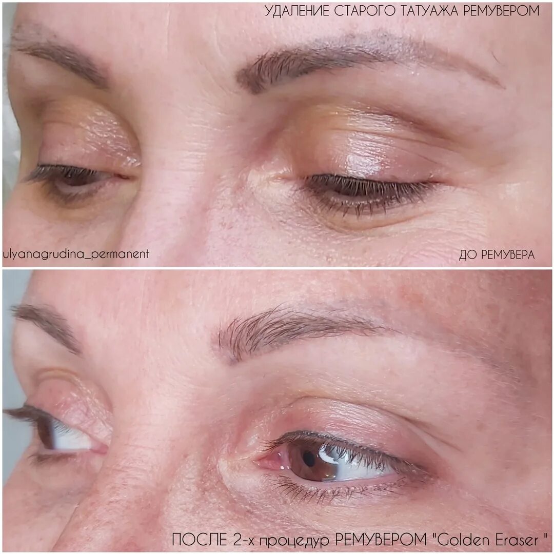 Удаление ремувером. Удаление ремувером видео. Удаление ремувером видео. Удаление ремувером видео. Удаление ремувером видео.