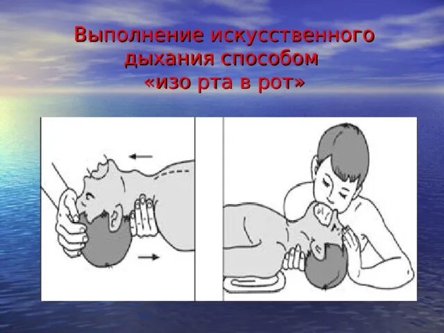Искусственное дыхание рот в нос. Искусственное дыхание методом рот в нос. способы искусственного дыхания.