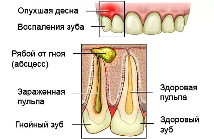 Как отличить зубную боль от воспаления. Флюс воспаление десны гной. Периостит надкостницы челюсти. Пульпит Гнойный (пульпарный абсцесс.