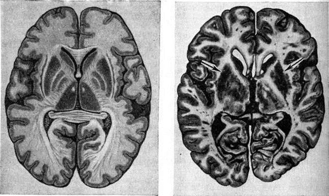 Атрофия головного мозга лечение. Сенильная дегенерация головного мозга. Атрофические заболевания головного мозга пика. Церебральная дегенерация это.