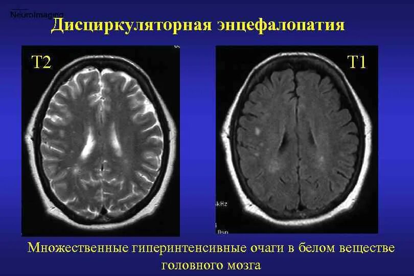 Дисциркуляторная энцефалопатия мрт. Дисциркуляторная энцефалопатия головного мозга на кт. Сосудистая энцефалопатия головного мозга на кт. Дисциркуляторная энцефалопатия кт мрт. Дисциркуляторные дистрофические изменения