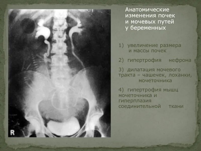 Дилатация мочеточника. Дилатация мочевых путей. Викарное расширение почки.