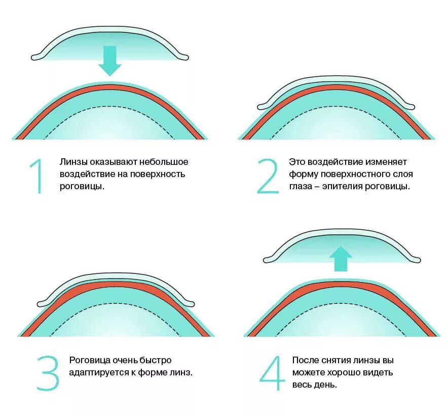 Линзы для глаз минусы. Формы контактных линз. Правильная форма контактной линзы. Октореалогические линзы. Структура контактной линзы.