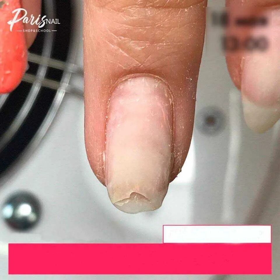 Отслойки на ногтях гель лака. Отслойка покрытия на ногтях. Отслойки под ногтями маникюр. Почему гелевые ногти