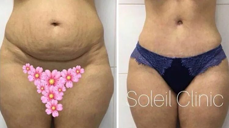 Son Système! Remarquablement Efficace laser vaginale équipements rajeunissement 