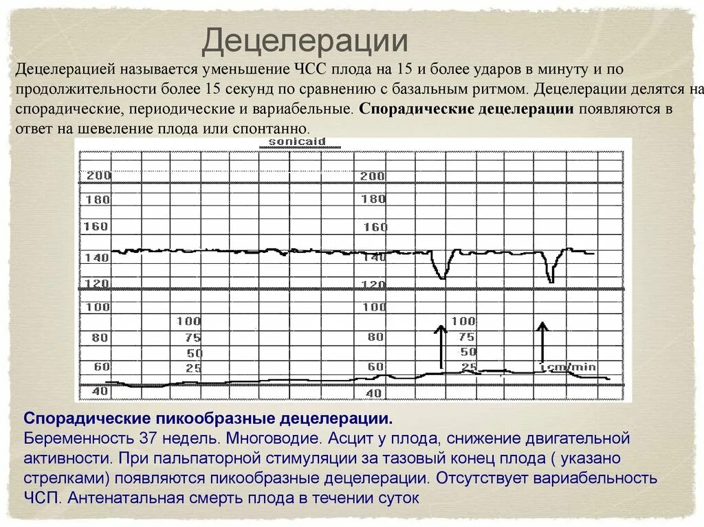 Как определить сердцебиение ребенка. Поздние децелерации на КТГ. Акселерация и децелерация на КТГ. КТГ плода децелерации. КТГ плода расшифровка акцелерации и децелерации.