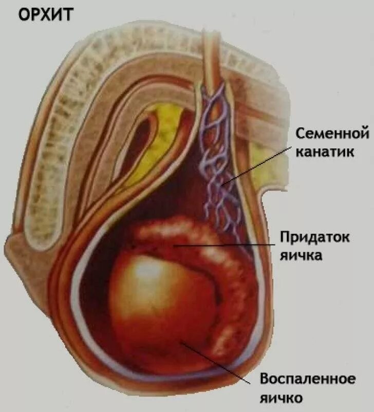 Эпидидимит яийа. Анатомия яичка и семенного канатика.