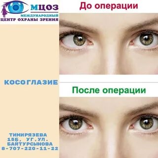 Косые глаза это