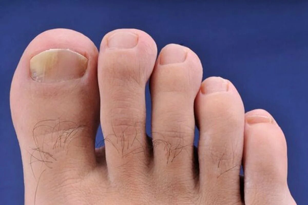 Лечение ногтевого грибка на ногах. Эпидермофития рубромикоз. Гиперкератотический онихомикоз. Экзодерил от грибка ногтей.