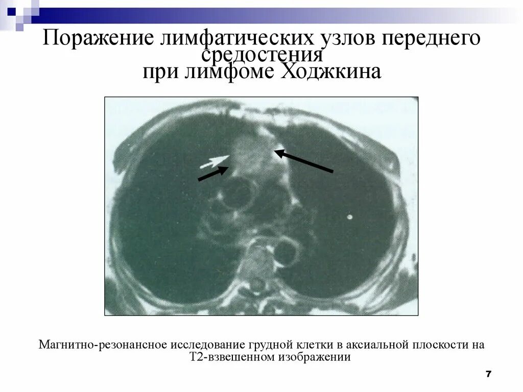 Лимфоузел после химиотерапии. Кт увеличенные лимфатические узлы средостения. Ходжкинская лимфома на кт. Медиастинальные лимфатические узлы на кт. Кт лимфоузлов средостения.