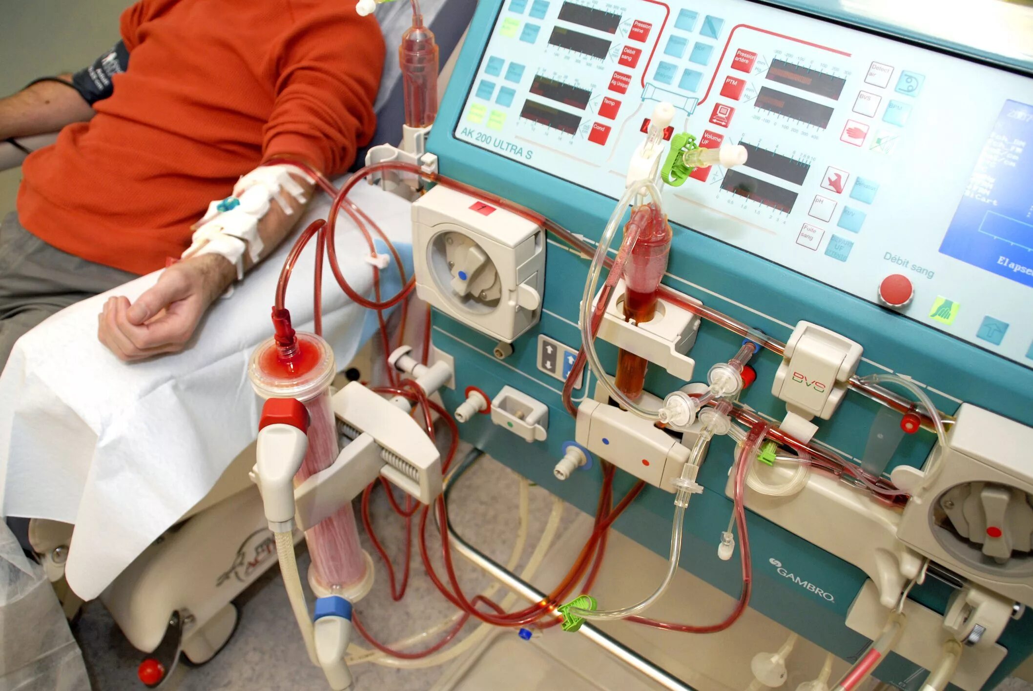 Плазмоферез что это. Гемофеникс аппарат для плазмафереза. Plasmapheresis аппарат. Аппарат Haemonetics плазмаферез.