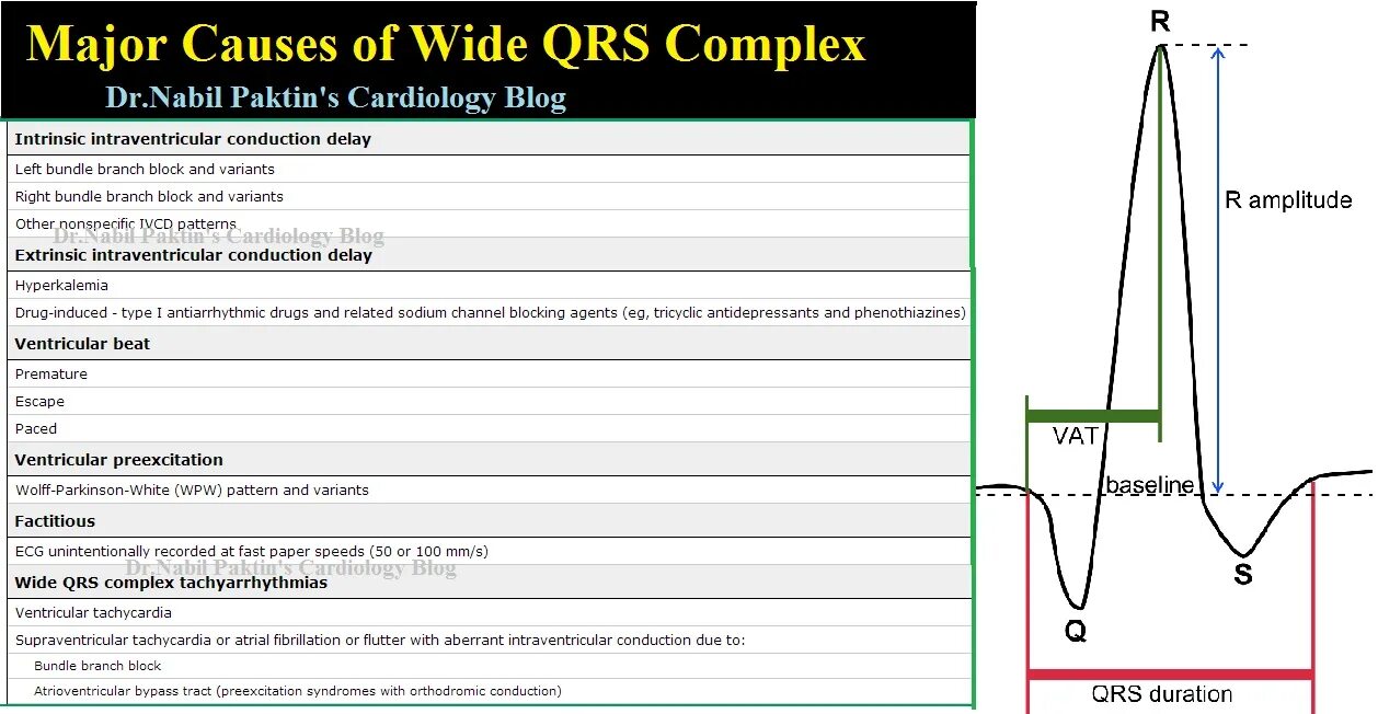 Major cause. Паузы выпадения QRS. Паузы выпадения QRS норма. Вибромашинка QRS. Паузы выпадения QRS 29 секунд.