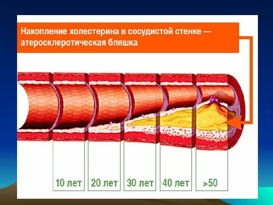 Выраженный атеросклероз
