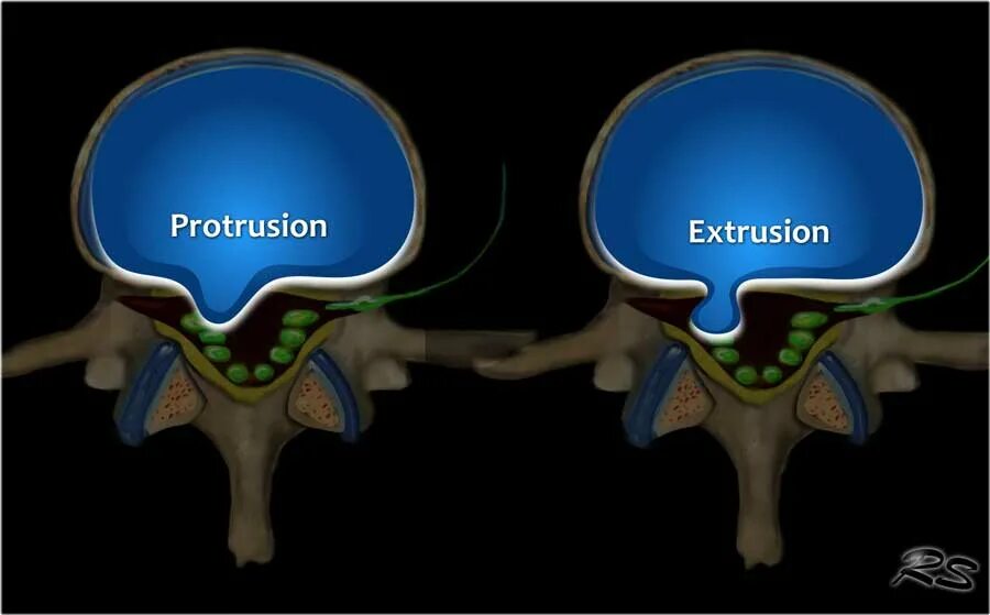 Парамедианная экструзия межпозвоночного диска. Экструзия и протрузия межпозвоночного диска. Медианно-парамедианная протрузия диска. Протрузия межпозвонковых дисков кт. Диффузная протрузия межпозвонковых