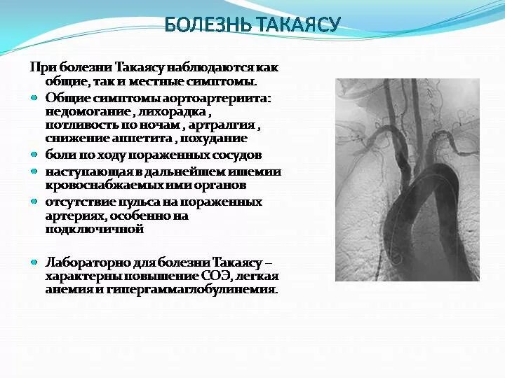 Неспецифический аортоартериит патогенез. Болезнь такаясу клинические. Болезнь такаясу синдромы. Болезнь такаясу клинические. Патогенез аортоартериита такаясу.