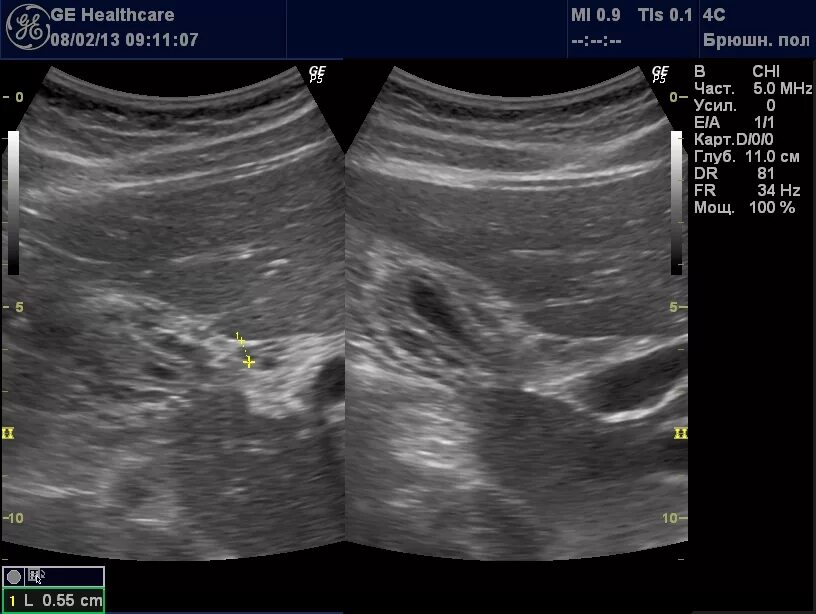 Кальцинат в печени на узи. Гепатоспленомегалия на УЗИ. Эхограмма острого гепатита. УЗИ картина гепатита печени. Острый гепатит УЗИ картина.